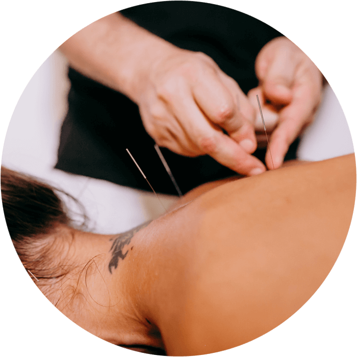Acupuncture near me