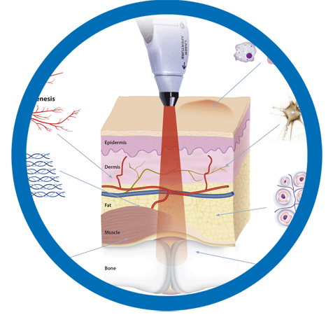 Deep Penetrating Laser